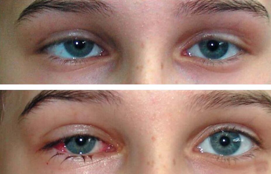 Antes e depois do tratamento Oculax