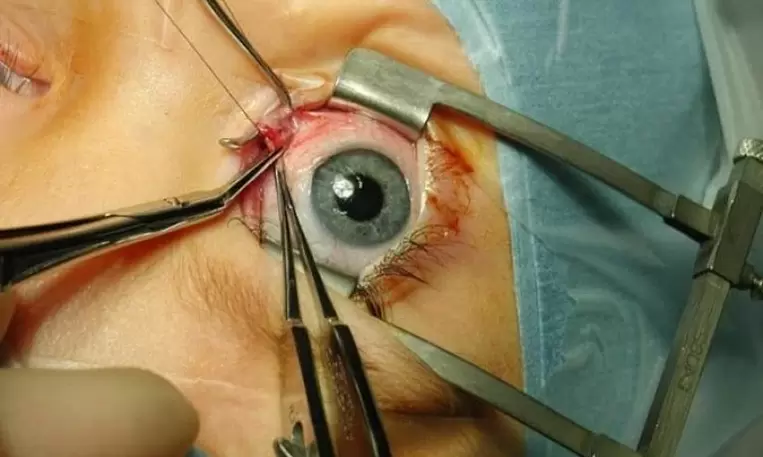 Realizando cirurgia ocular usando um espéculo palpebral